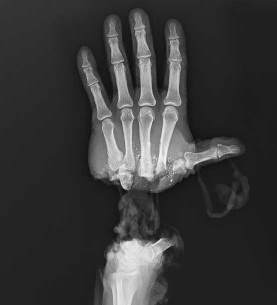 x ray of a hand cut