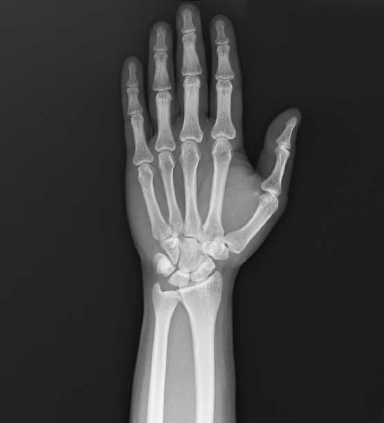 x-ray of a hand